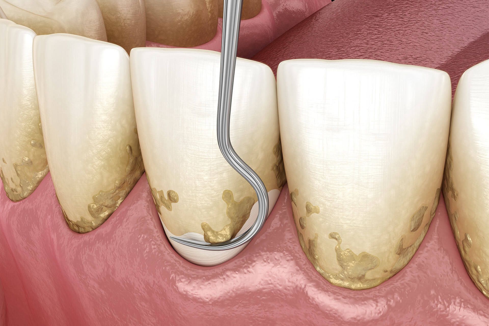 Periodontal Scaling & Root Planing